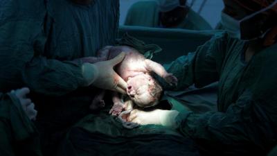 Baby gut study finds bacteria different after C-section births