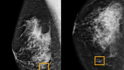 Google system could improve breast cancer detection: Study